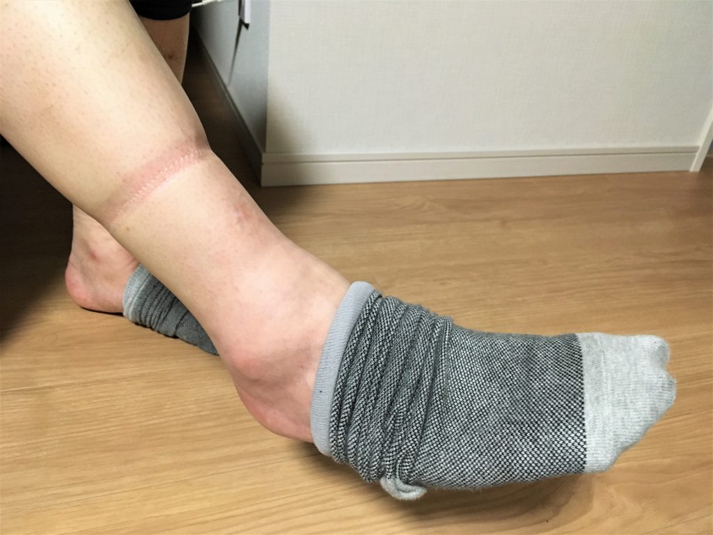 むくみ 靴下跡 下肢静脈瘤