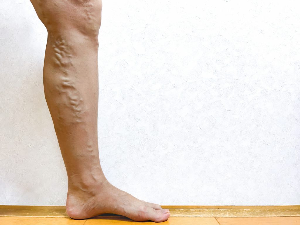 下肢静脈瘤 血管浮き出る こぶ