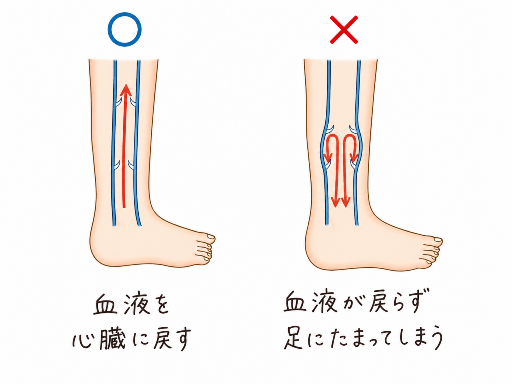 下肢静脈瘤
